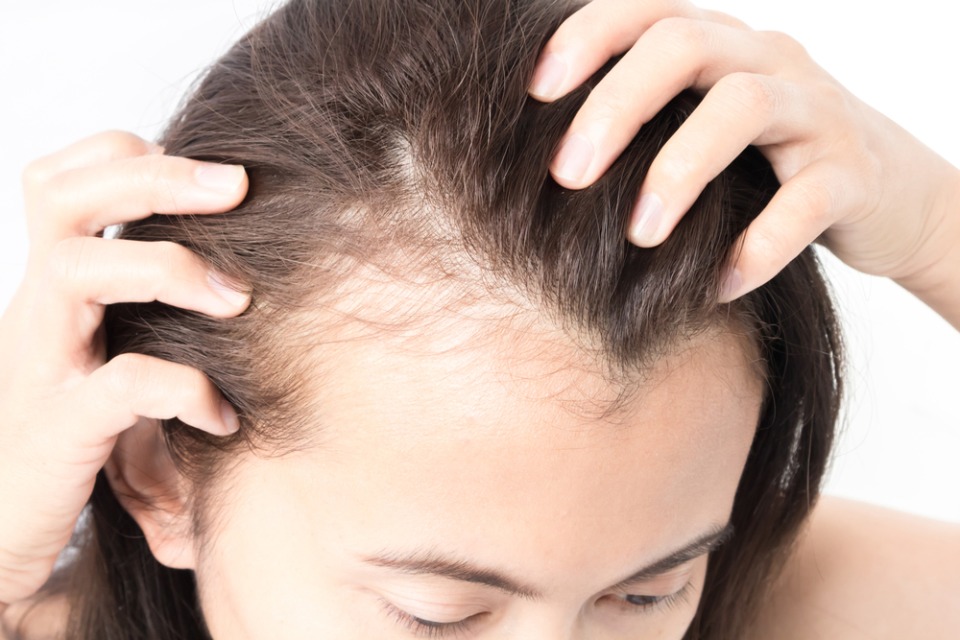 Hair transplant Istanbul for Natural Looking Hairlines